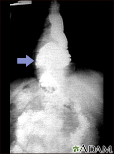 Hiatal hernia - X-ray Hiatal hernia - X-ray