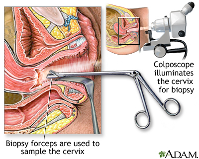 Colposcopy-directed biopsy Colposcopy-directed biopsy