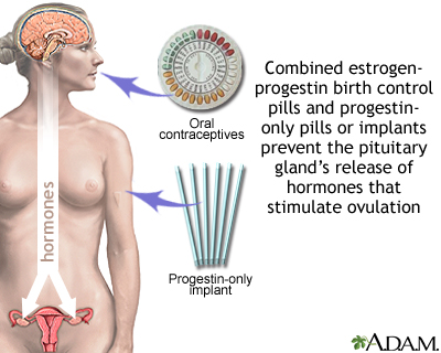 Hormone-based contraceptives Hormone-based contraceptives