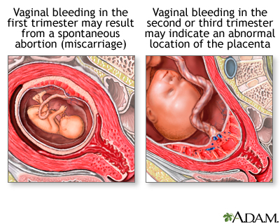 Vaginal bleeding during pregnancy Vaginal bleeding during pregnancy