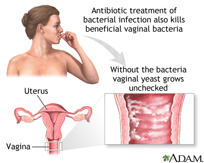 Secondary infection Secondary infection