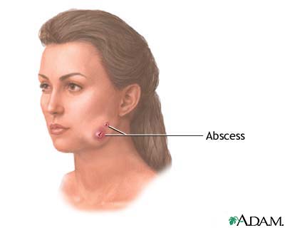 Actinomycosis (lumpy jaw) Actinomycosis (lumpy jaw)