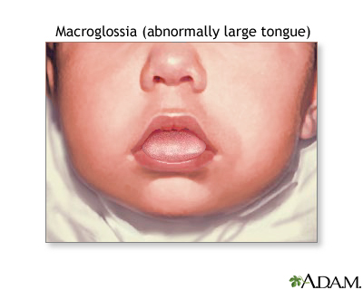 Macroglossia Macroglossia