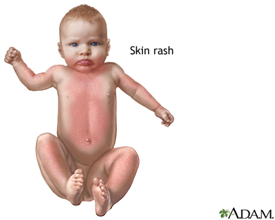 Rubella Rubella