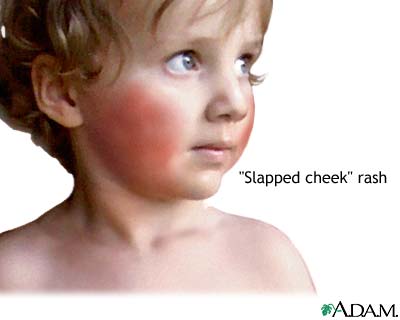 Fifth disease Fifth disease