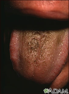 Black hairy tongue Black hairy tongue