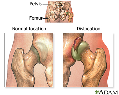 Dislocation of the hip Dislocation of the hip