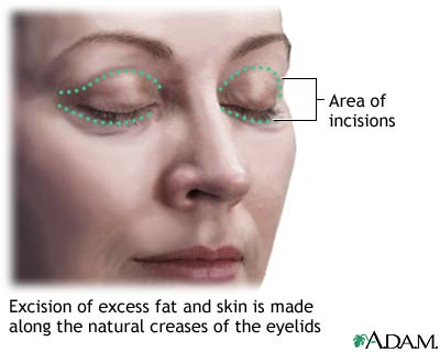Incisions Incisions
