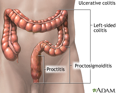 Ulcerative colitis Ulcerative colitis