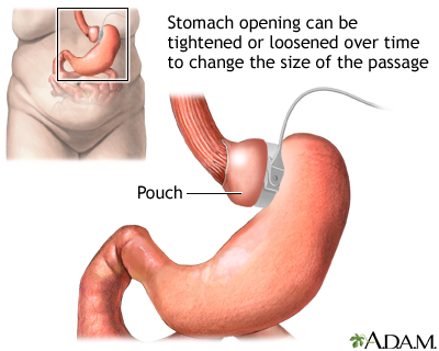 Adjustable gastric banding Adjustable gastric banding