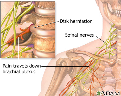 Neck pain Neck pain