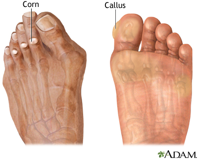 Corns and calluses Corns and calluses