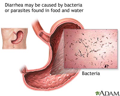 Diarrhea Diarrhea