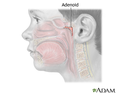 Adenoid removal - Series Adenoid removal - Series