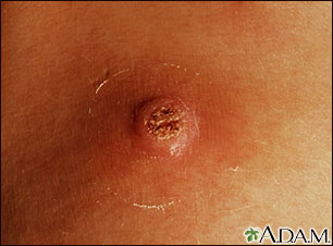 Wart (close-up) Wart (close-up)