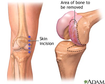 Incision Incision
