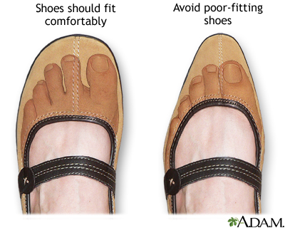 Proper fitting shoe Proper fitting shoe