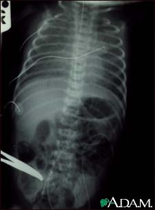 Totally anomalous pulmonary venous return - X-ray Totally anomalous pulmonary venous return - X-ray