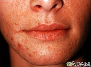 Perioral dermatitis Perioral dermatitis