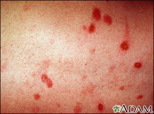 Erythema multiforme on the leg Erythema multiforme on the leg