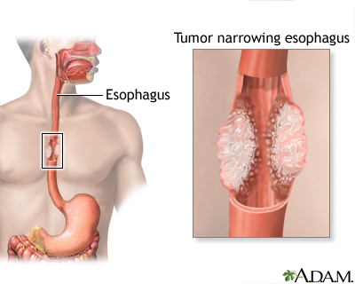 Esophageal cancer Esophageal cancer