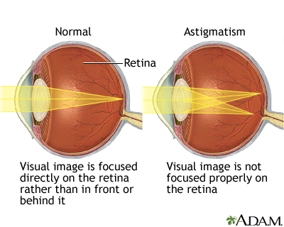 Astigmatism Astigmatism