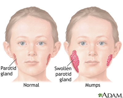Mumps Mumps