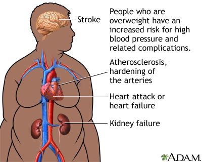 Obesity and health Obesity and health