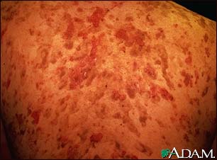 Pemphigus vulgaris on the back