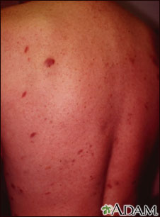Kaposi sarcoma on the back Kaposi sarcoma on the back