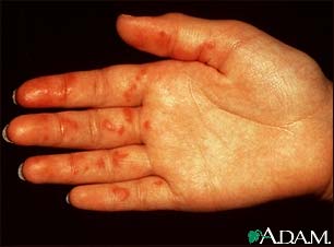 Vasculitis on the palm Vasculitis on the palm