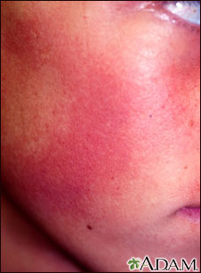 Keratosis pilaris rubra faceii Keratosis pilaris rubra faceii