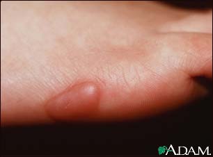 Keloid - on the foot