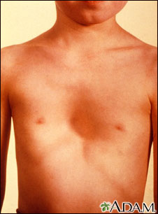 Pectus excavatum Pectus excavatum