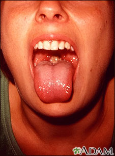 Mononucleosis - mouth Mononucleosis - mouth