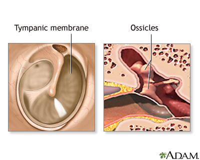 Eardrum repair - series