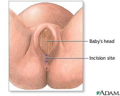 Indication Indication