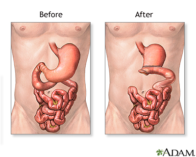 Before and after gastrectomy Before and after gastrectomy