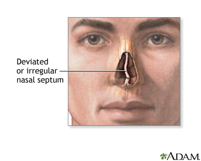 Indications - Septal deviation Indications - Septal deviation