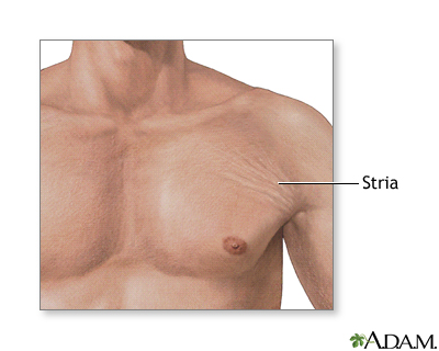 Stria Stria