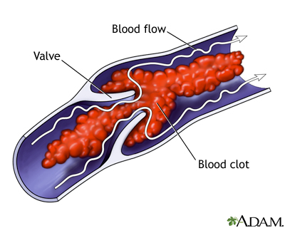 Venous blood clot Venous blood clot