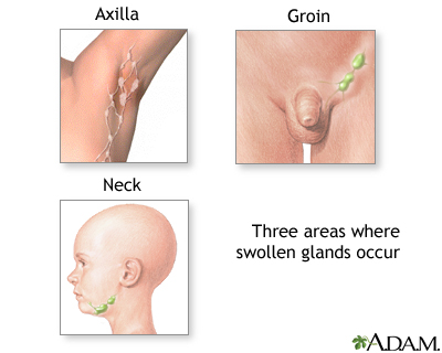 Swollen glands Swollen glands