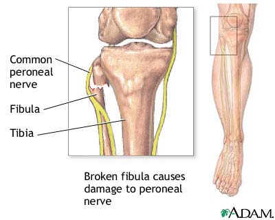 Common peroneal nerve dysfunction Common peroneal nerve dysfunction