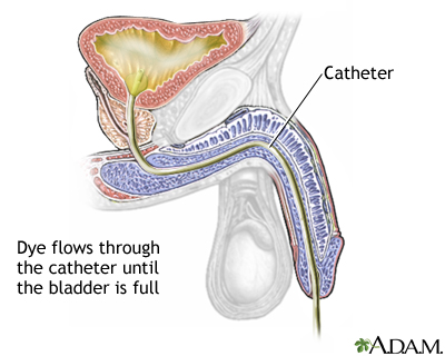 Cystography Cystography