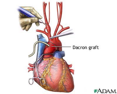 Prosthetic graft placement Prosthetic graft placement