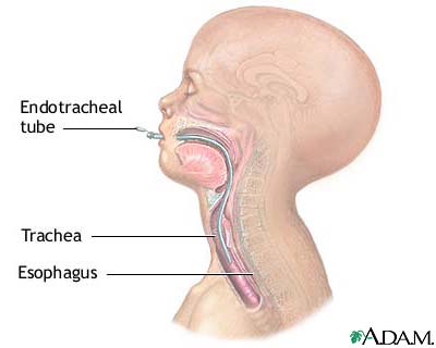 Endotracheal intubation Endotracheal intubation