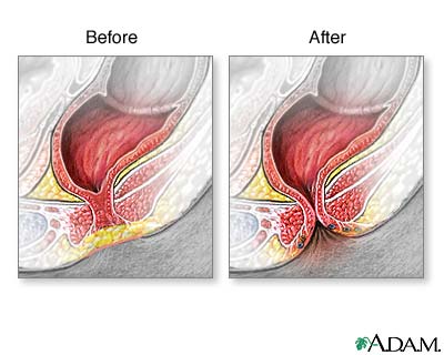 Imperforate anus Imperforate anus
