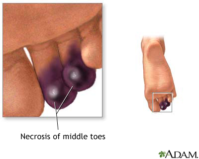 Necrosis of the toes Necrosis of the toes