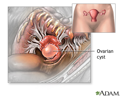 Ovarian cyst Ovarian cyst
