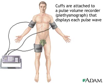 Plethysmography Plethysmography